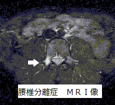 腰痛分離症 MRI像