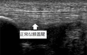 正常な膝蓋腱