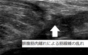 腓腹筋肉離れによる筋繊維の乱れ