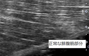 正常な腓腹筋部分