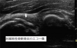 肘 離断性骨軟骨炎 エコー像