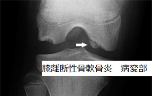 膝 離断性骨軟骨炎 病変部