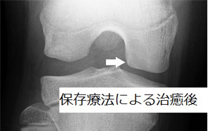 保存療法による治癒後