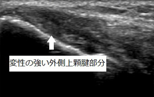 変性の強い外側上顆腱部分