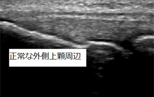 正常な外側上顆周辺