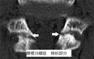 腰椎分離症 骨折部分