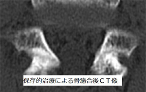 骨癒合後のCT像